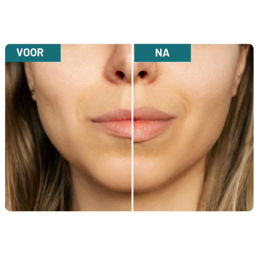 Glow Fusion 2-Dos Anti-Åldrande Serum | Avancerat Mikronålsinfusionskit för Strålande Hud