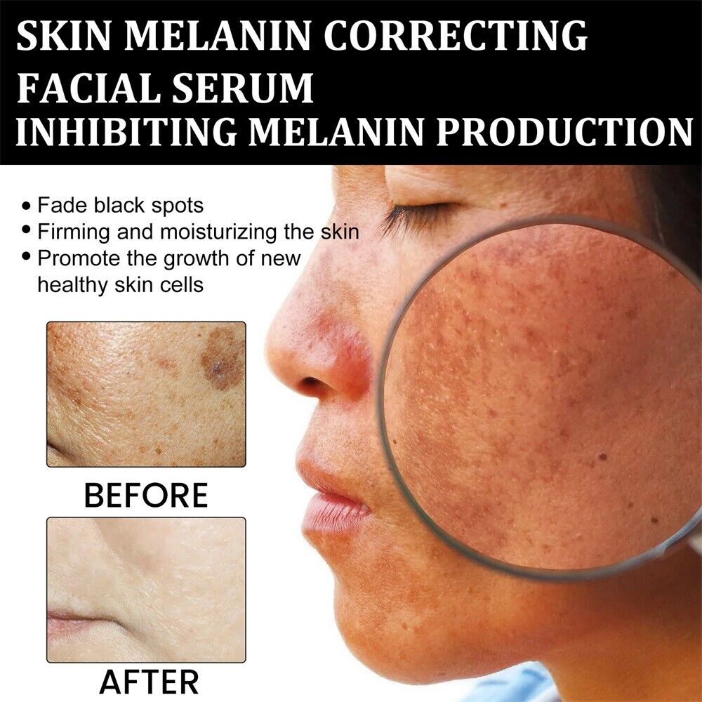 ✨ LUMISKIN™ Snabb Borttagning av Mörka Fläckar - Melanin Korrigerande Ansiktsserum