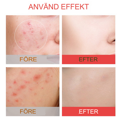ClearSkin Akneöverdrag | Osynlig Hydrokolloid Behandling för Fläckfri Hud